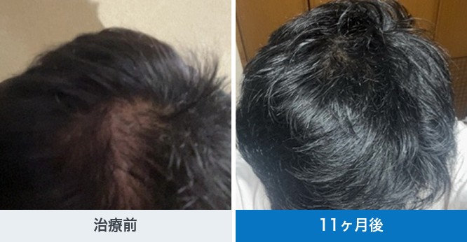 クリニックフォアが公開している40代の発毛ライトプランの経過写真