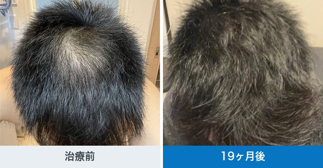 クリニックフォアが公開している40代の予防プランの経過写真