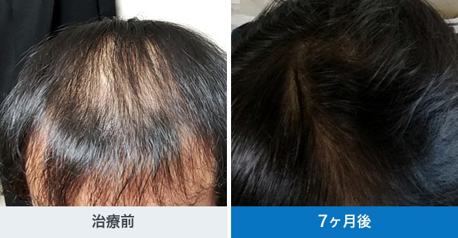 クリニックフォアが公開している40代の予防プランの経過写真