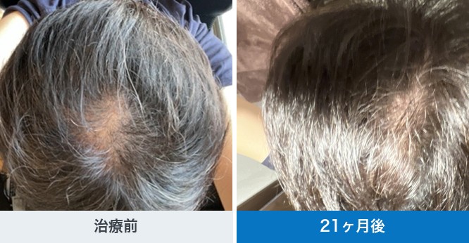 クリニックフォアで公開されているAGA治療の経過写真