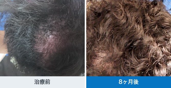 クリニックフォアで公開されているAGA治療の経過写真