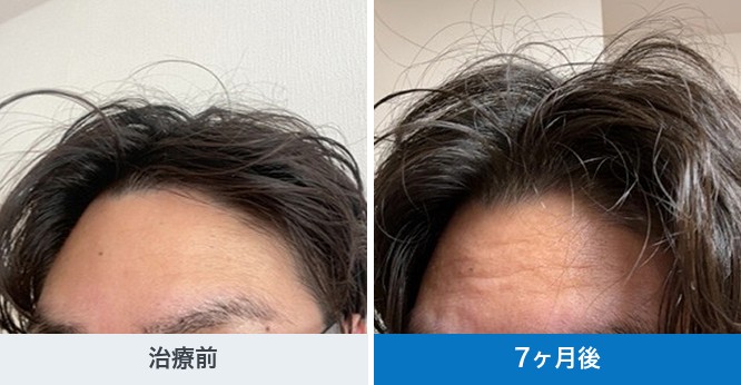 クリニックフォアが公開している30代の発毛ライトプランEXの経過写真