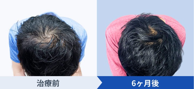 DMMオンラインクリニックが公開している発毛ストロングプランの経過写真