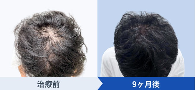 DMMオンラインクリニックが公開している発毛ライトプランの経過写真