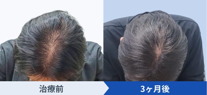 DMMオンラインクリニックが公開している発毛ライトプランの経過写真