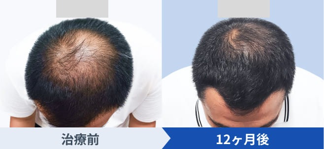 DMMオンラインクリニックが公開している発毛ベーシックプランの経過写真