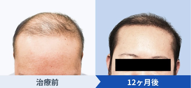 DMMオンラインクリニックが公開している発毛ストロングプランの経過写真